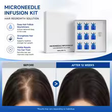 Kit Microneedling pour la Repousse des Cheveux – Sérum Nourrissant du Cuir Chevelu